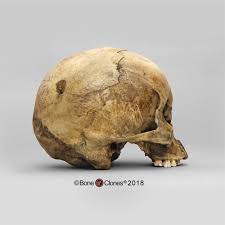 Nur amirah sulaiman, khairul osman, noor hazfalinda hamzah, and sri deaths due to blunt force trauma to the head as a result of assault are some of the most common cases encountered by the practicing forensic. Human Male Cranium With Mid Facial Blunt Force Trauma Bone Clones Inc Osteological Reproductions