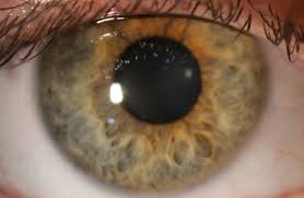 Image result for Eye Foreign Body
