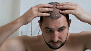 It is unusual for men to start losing their hair in their teens, but this can happen. Fight Against Hair Loss In Stock Footage Video 100 Royalty Free 1041936940 Shutterstock