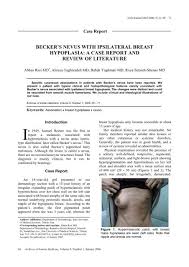 On, affecting, or monocular stimulation increases deoxyglucose uptake in ipsilateral primary optic centers of the rat. Becker S Nevus With Ipsilateral Breast Hypoplasia A