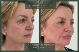 POLYNUCLEOTIDE BEFORE AND AFTER PICTURES