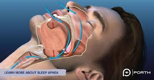 Image result for Obstructive Sleep Apnea