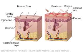 Image result for psoriasis