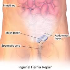 Image result for Inguinal hernia man