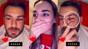 Julien Bert Blesse Par Hilona Il Devoile Un Impressionnant œil Au Beurre Noir