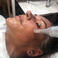 Eclipse micropen is a safe treatment for most skin types, including sensitive skin. Micro Needling Face Treatment And Consultation Halifax Aurora Cosmetics