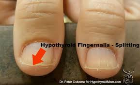 Do You Have Hypothyroidism Look At Your Hands Hypothyroid Mom Nail Health Signs Health Signs Hypothyroidism Symptoms