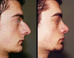 Tου Dr. med. Βασίλη Παυλιδέλη Χειρουργός ΩΡΛ • Eξειδικευμένος στη  Ρινοπλαστική