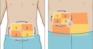 Check spelling or type a new query. Selecting The Injection Site