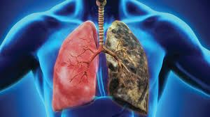 Anyone can develop lung cancer, but cigarette smoking and having exposure to smoke, inhaled chemicals, or other toxins can increase the risk. Causes Of Lung Cancer Smoking Room