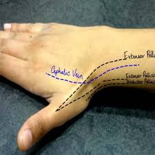 This Highlights A Typical Image Of The Surface Anatomy Drawn On In Download Scientific Diagram *the contents of anatomical snuff box are : surface anatomy drawn