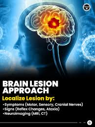Image result for Neurologic Lesion Localization