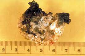 Uric Acid Calcium Oxalate Monohydrate Kidney Stone Stonedisease Org