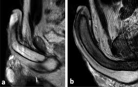 Image result for Priapism