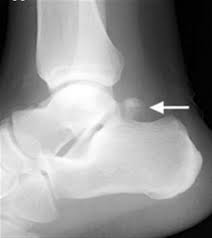 Lower Extremity Os Foot Ankle Orthobullets