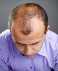 It strikes in one's thirties (usually) and the first usual symptom of male pattern baldness is a receding hairline at the forehead. What Is Terminal Hair With Pictures