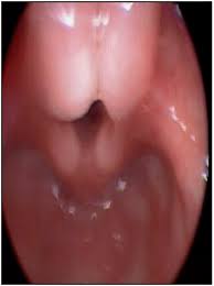 Learn more about what causes laryngomalacia, symptoms and treatment. Supraglotoplastia Laser En Laringomalacia Severa