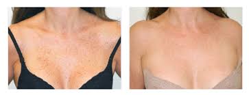 People start appreciating results after even one session. Before And After Renova Laser Hair Removal Medspa Houston Tx