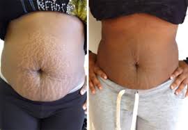 Check spelling or type a new query. An Open Letter To People Who Want To Erase Stretch Marks Extremely Fast Sidewap Com Ng Best Online Portal For Nigerian News World S Top Notch Blog For Latest Entertainment News Celebrity Gossips