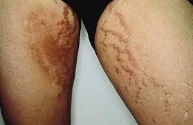Hi, most posts i see about red rashes on the inner thigh are about jock itch. Dermatologic Diseases In Pregnancy Glowm