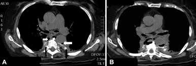 ( a from levine ms: A Creeping Malaise Leading To Calamity Herpes Esophagitis Perforation The Annals Of Thoracic Surgery