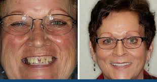 Image result for dentures