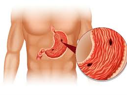 Some throat cancers provoke ear pain, which can be severe. What Are The Symptoms Of Stomach Cancer In Tamil