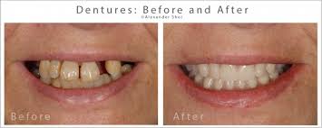 Maybe you would like to learn more about one of these? Dentures Before After Seattle Shor Dental