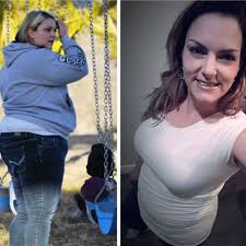 You get a smaller stomach pouch, which attaches lower down your small intestine. Gastric Sleeve Before And After Photos The Best Pictures Of 2020