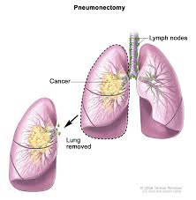 Can a person live with one lung. Non Small Cell Lung Cancer Hematology Oncology Associates Of Cny