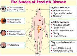 We did not find results for: Comorbilidades En Psoriasis Articulos Intramed
