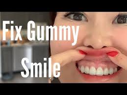 Gummy smiles, and how to fix them. Kokofaceyoga Youtube Face Yoga Face Yoga Exercises Gummy Smile