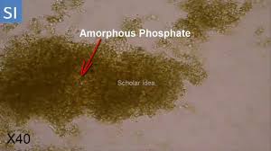 Amorphous Phosphate Crystals In Urine Youtube