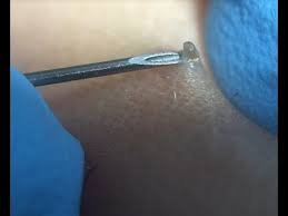 Epidermoid cyst epidermoid cyst removal epidermoid cyst treatment exploding cysts and boils videos giant cyst popping on youtube giant pus filled cyst explosion how long does it take for an abscess to drain on its own how to drain an abscess at home ingrown hair ingrown hair pictures itchy cyst pictures of. Removing Ingrown Hairs Before Electrolysis Session Youtube