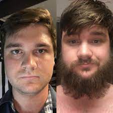 Although the problem of facial hair is rarely serious, it can cause embarrassment to some women. 6 Months Of Growth Beards