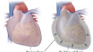 Heart failure occurs when the heart isn't pumping as well as it should. My Pericarditis Or Heart Fluid Buildup I Think It Was Caused By An Infection It Happened Suddenly Youtube