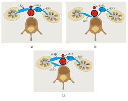 What Each Clinical Anatomist Has To Know About Left Renal Vein Entrapment Syndrome Nutcracker Syndrome A Review Of The Most Important Findings Abstract Europe Pmc