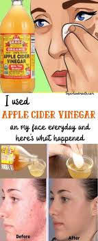 Reasons Why Apple Cider Vinegar Toner Is Getting More Popular In The Past  Decade