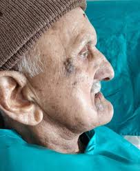 3D Caramel Floating Denture: A Salvage From High Interarch Space