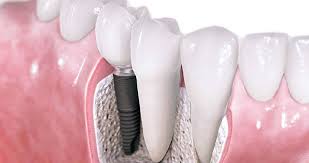 We did not find results for: Ganti Gigi Hilang