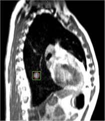 Radiation oncologists in australia make close to $175,300. Reliability Of Itv Approach To Varying Treatment Fraction Time A Retrospective Analysis Based On 2d Cine Mr Images Radiation Oncology Full Text