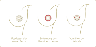 Brustwarze (auch mamille, lateinisch mamilla, das ist der diminutiv von lateinisch mamma „weibliche brust; Brustwarzenkorrektur Kosten Risiken Behandlung Mooci