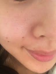 Include (or exclude) self posts. è‚Œæ–­é£Ÿã«ã¤ã„ã¦ã§ã™ ä»Š å®‡æ´¥æœ¨å¼ã®è‚Œæ–­é£Ÿã‚'ã—ã¦ 8ãƒ¶æœˆã«ãªã‚Šã¾ã™ æœ€åˆäºŒ ä¸‰ãƒ¶ Yahoo çŸ¥æµè¢‹