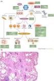 Chronic Inflammation - an overview | ScienceDirect Topics