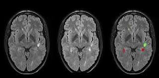 Prognostic Value Of White Matter Lesion Shrinking In Early Multiple Sclerosis An Intuitive Or Naive Notion Pongratz 2019 Brain And Behavior Wiley Online Library