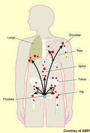 More advanced prostate cancers can sometimes cause symptoms, such as: Zytiga Abiraterone Acetate Treatment Of Metastatic Castration Resistant Prostate Cancer Mcrpc Clinical Trials Arena