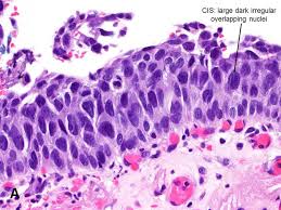 While they are a form of neoplasm, there is disagreement over whether cis should be classified as cancer. Urothelial Carcinoma In Situ American Urological Association