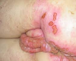 In general, bumps on buttocks is normally defined as the plugged pores, pimples and the cysts. Treatment Of Acyclovir Resistant Herpes Simplex Virus With Continuous Infusion Of High Dose Acyclovir In Hematopoietic Cell Transplant Patients Biology Of Blood And Marrow Transplantation