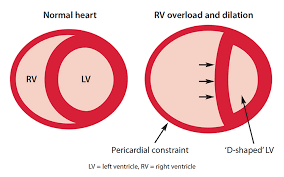 Image result for Right Heart Failure
