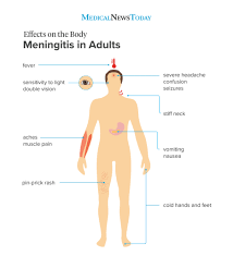 Bacterial meningitis is an infection, caused by bacteria, of the sac surrounding the brain and spinal cord. Meningitis Rash Pictures Symptoms And Similar Rashes